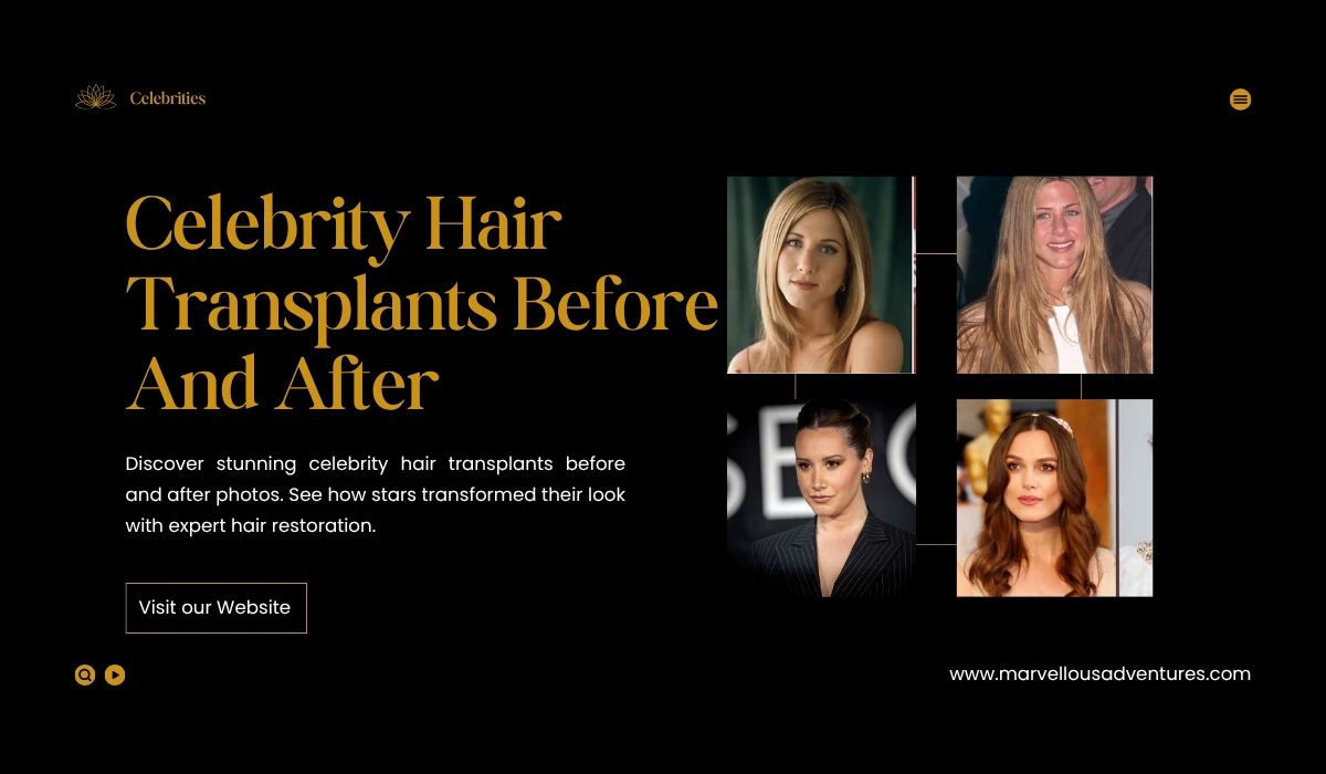 Famous Celebrity Hair Transplants Before and After Transformations